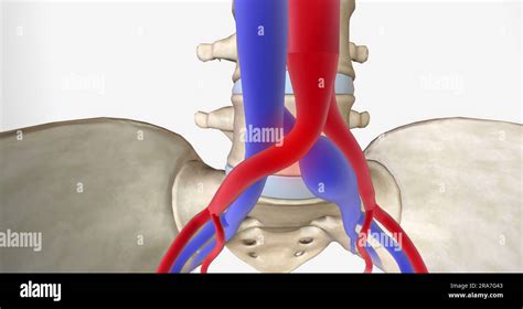 right common iliac vein compression